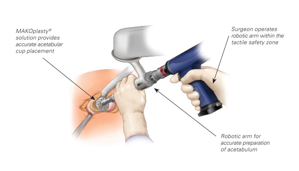 Mako Robotic Arm Assisted Surgery Comanche County Memorial Hospital